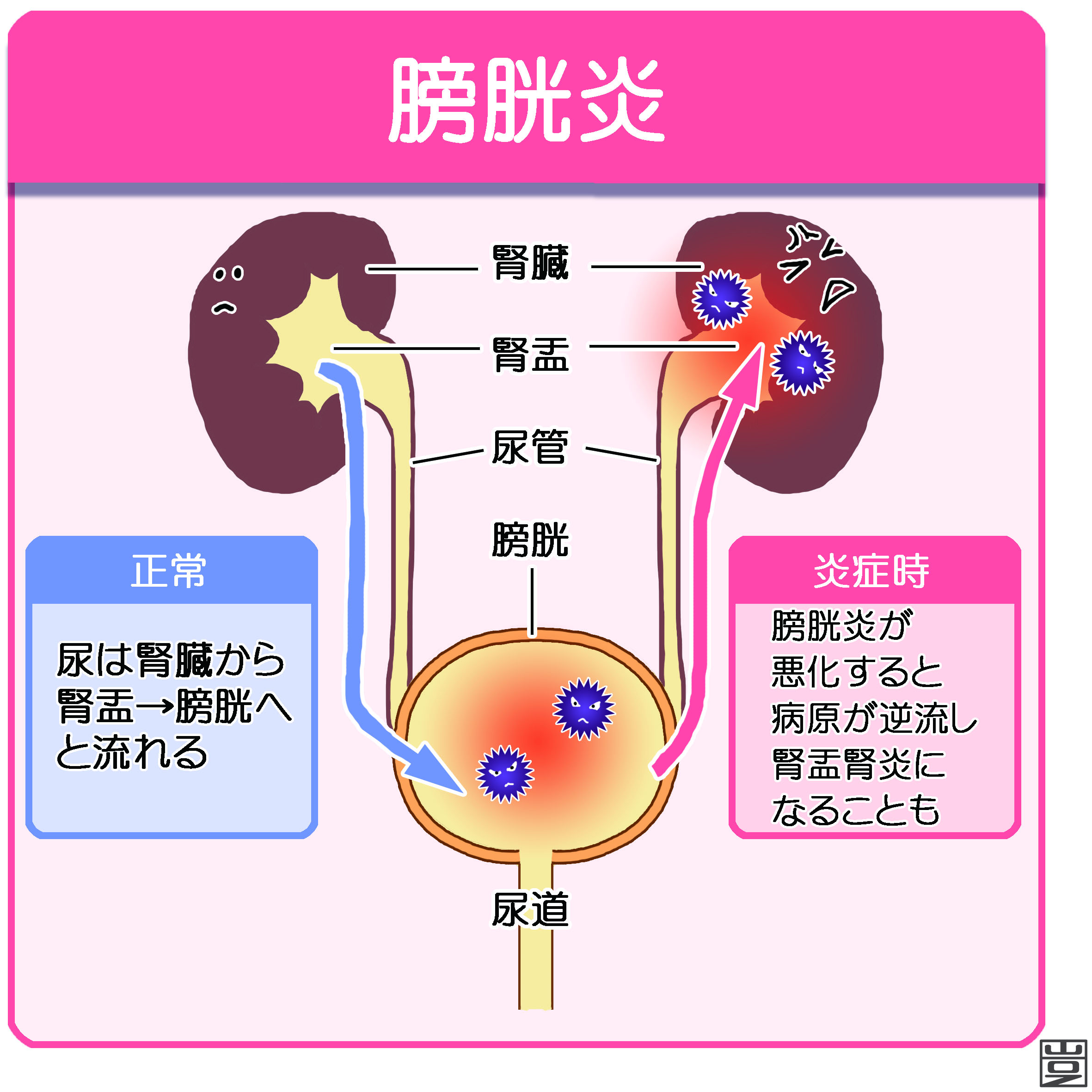 膀胱炎とは？原因・症状・検査・治療など 新宿駅前クリニック泌尿器科