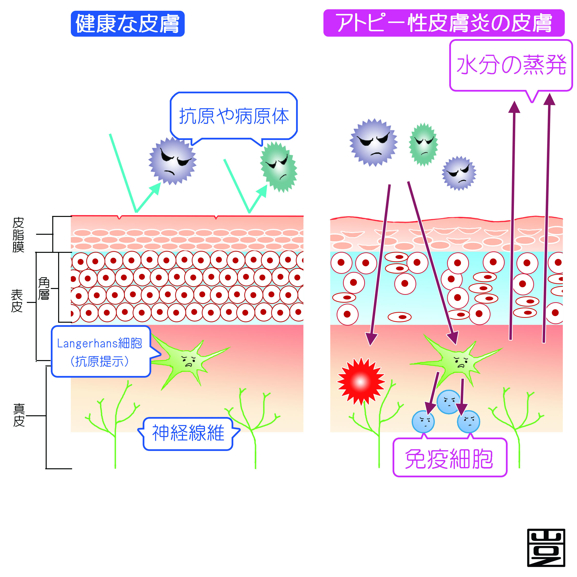 炎 皮膚 アトピー 性 アトピー性皮膚炎の本当の原因