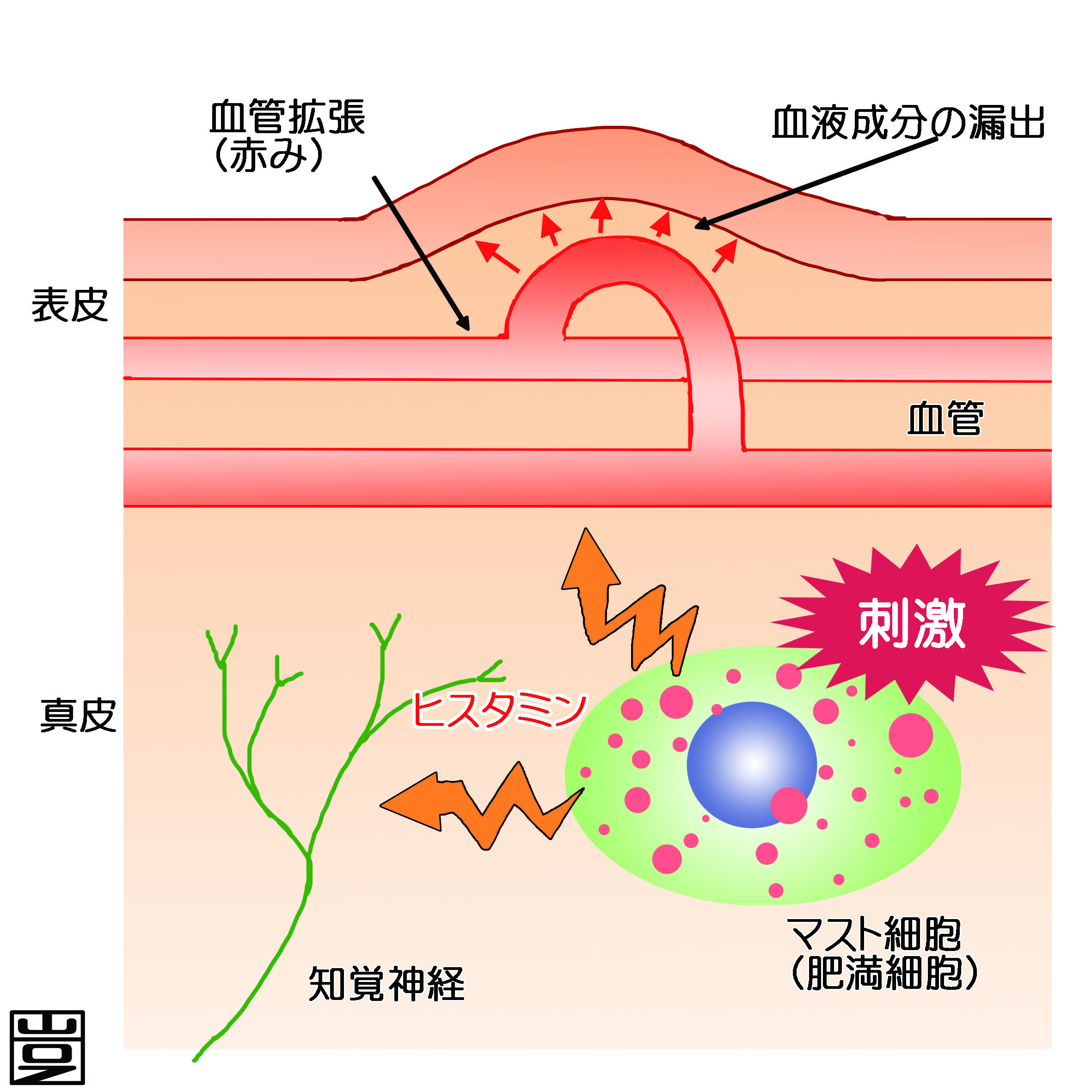 じんましん