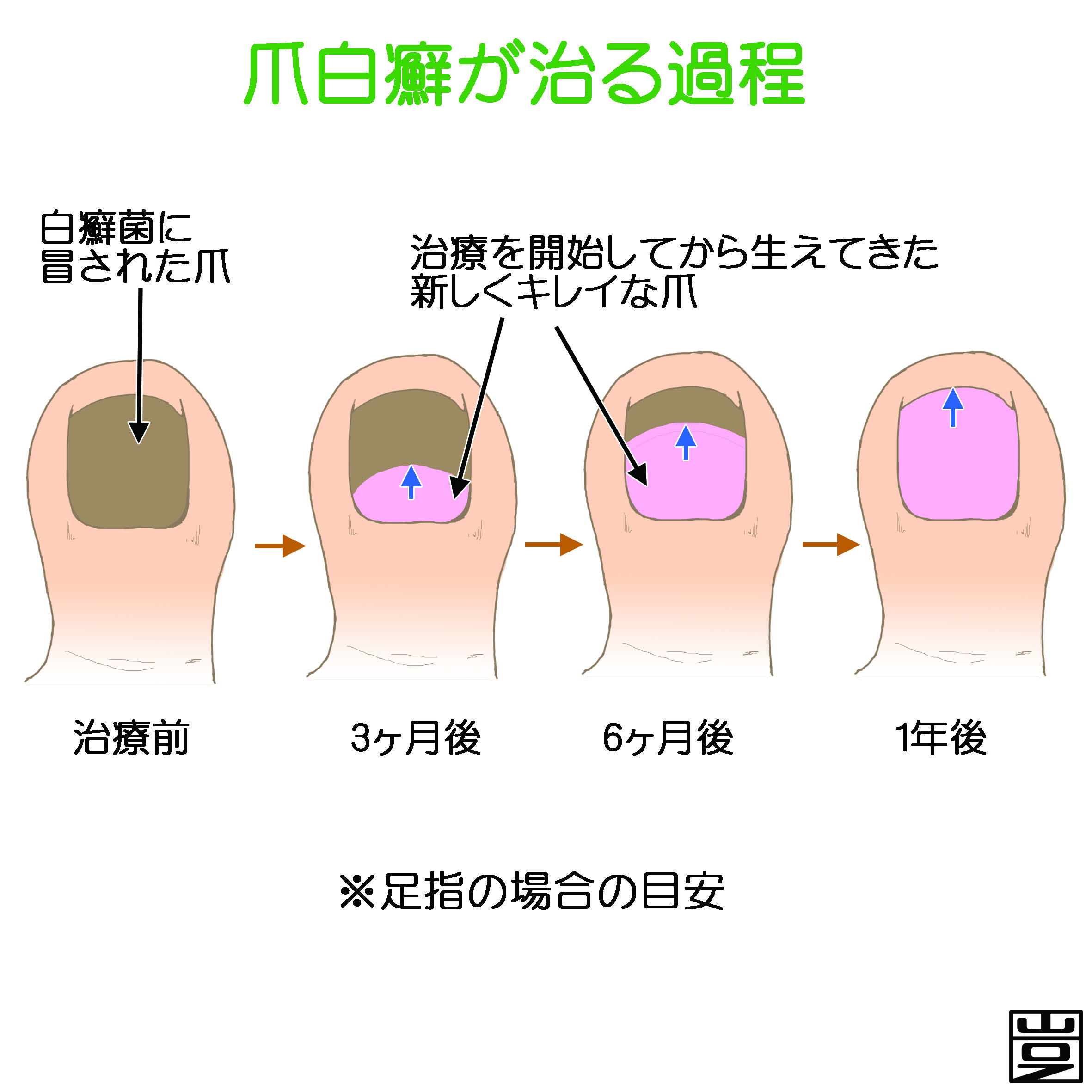 爪水虫