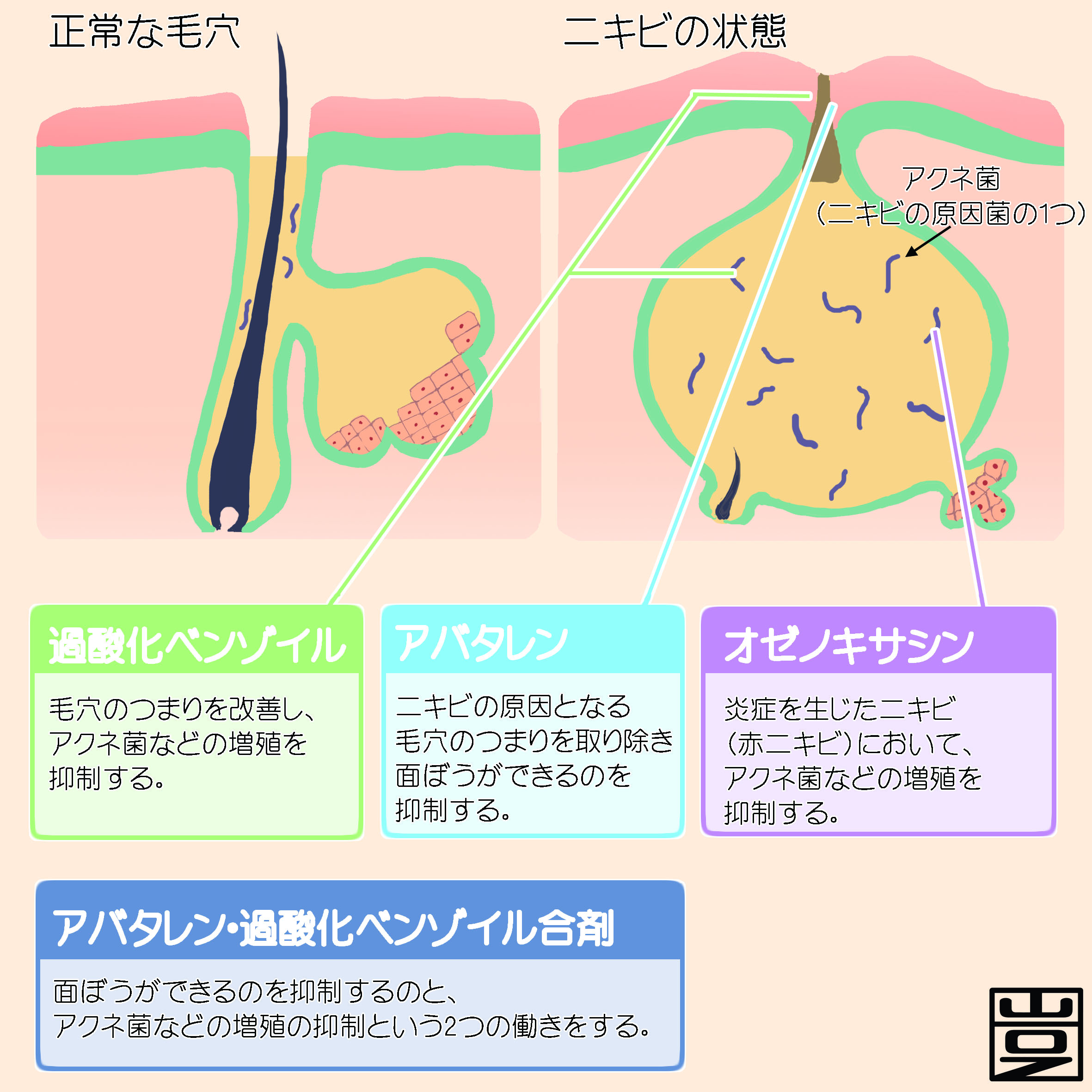 ニキビの原因