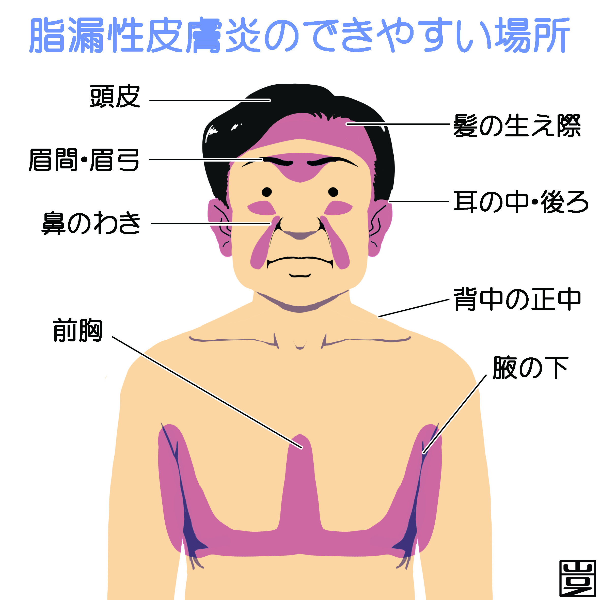 脂漏性皮膚炎とは 原因 症状 治療など 新宿駅前クリニック皮膚科